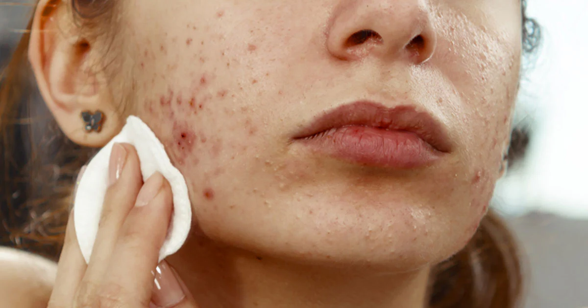 What Causes Acne—And Why Your Face Wash Can't Fix It